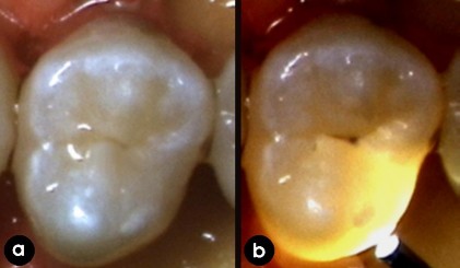Hình 1 5 Hình ảnh FOTI trên răng a nhìn bằng mắt thường b hình ảnh với 5