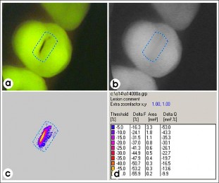 Hình 1 6 Thiết bị QLF 49 Hạn chế của QLF là khó phát hiện các tổn thương 6
