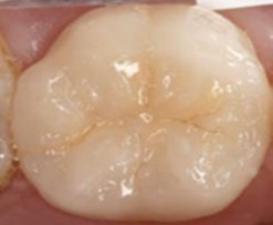 Hình 2 1 Mặt răng bình thường Mã 1 Mặt răng bình thường khi ướt xuất 1