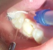 Hình 2 8 Mặt răng sau khi được làm sạch và làm khô Hình 2 9 Etching mặt răng 10