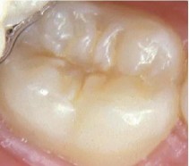 Hình 2 2 Đốm trắng đục sau khi thổi khô Mã 2 Đổi màu trắng đục hoặc nâu 2