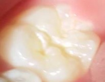 Hình 2 3 Đốm trắng đục trên men khi mặt răng ướt Mã 3 Tổn thương phá vỡ 3