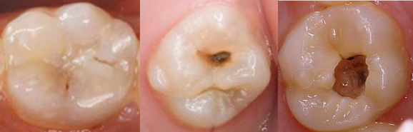 Hình 2 4 Tổn thương phá vỡ bề mặt men ngà răng bóng đen ánh lên từ ngà Mã 4