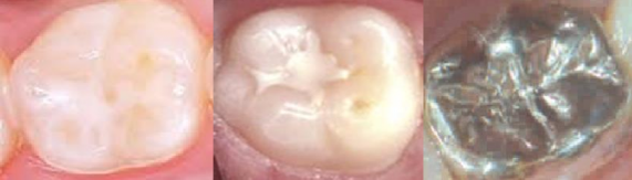 Hình 2 5 Mặt răng đã được can thiệp điều trị 3 Khám cận lâm sàng Khám 5