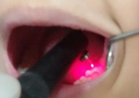 Hình 2 6 Đo mức khoáng hóa bằng thiết bị Diagnodent 2 1 4 3 Chẩn đoán và lập 6