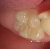 Hình 2 8 Mặt răng sau khi được làm sạch và làm khô Hình 2 9 Etching mặt răng 8