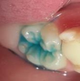 Hình 2 8 Mặt răng sau khi được làm sạch và làm khô Hình 2 9 Etching mặt răng 9