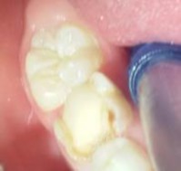 Hình 2 11 Làm khô mặt răng Hình 2 12 Phủ một lớp mỏng vật liệu lên mặt 1