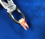 Hình 2 18 Xử lý răng hàm nhỏ vĩnh viễn sau khi nhổ 2 Chuẩn bị răng để 17