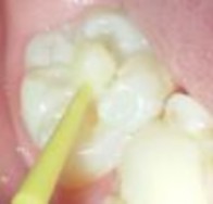 Hình 2 11 Làm khô mặt răng Hình 2 12 Phủ một lớp mỏng vật liệu lên mặt 2