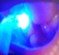 2 Chăm sóc răng miệng sau điều trị Hướng dẫn bệnh nhân cách vệ sinh răng 3