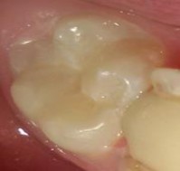 2 Chăm sóc răng miệng sau điều trị Hướng dẫn bệnh nhân cách vệ sinh răng 4