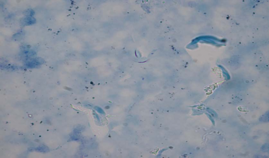 Ảnh 3 4 Kết quả nhuộm soi mẫu tăm bông số 1 quệt khay đựng đờm trong phòng 4