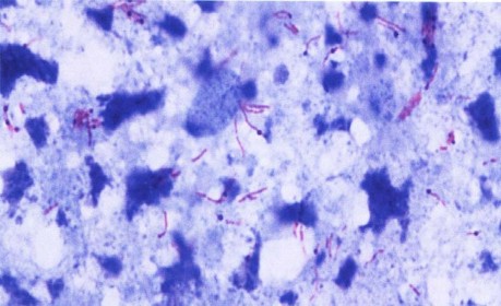 Ảnh 2 1 Vi khuẩn lao nhuộm Ziehl Neelsen 2 2 4 2 Phương pháp nuôi cấy tiến hành 1