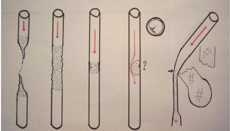A B C D E Hình 1 2 Các hình thái tổn thương động mạch do chấn thương A Đứt 2