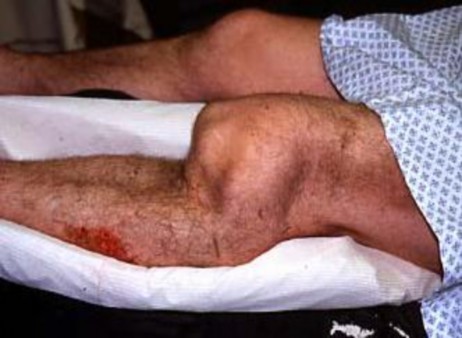 Ảnh 1 1 Hình ảnh sai khớp gối trái Nguồn theo Versier G 2006 120 Hội 1