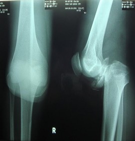 Ảnh 1 2 Hình ảnh Xquang gãy mâm chày ở BN đứt động mạch khoeo Nguồn theo 2