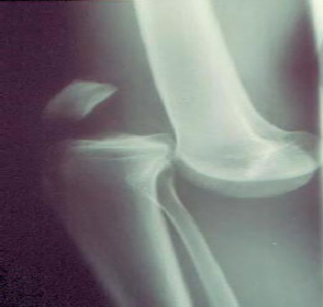 Ảnh 1 3 Hình ảnh Xquang sai khớp gối ở BN tổn thươngđộng mạch khoeo ⃰ 3