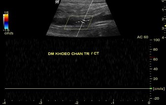 Ảnh 1 4 Hình ảnh siêu âm Doppler mất phổ sóng 3 pha động mạch khoeo Nguồn 4