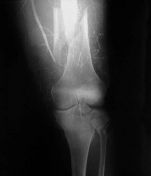 Ảnh 1 5 Hình ảnh tắc động mạch khoeo kết hợp gãy 1 3dưới xương đùi trên p 5