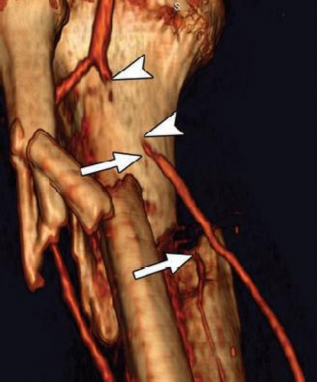 Ảnh 1 6 Hình ảnh tắc đoạn động mạch chày sau kèm gãy 1 3 trên xương cẳng 1