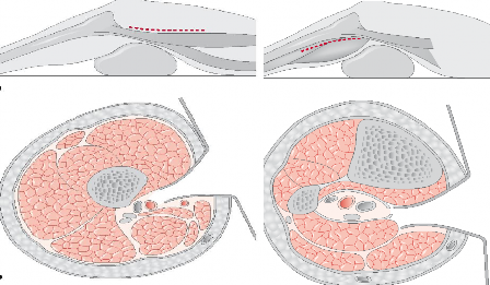 A B Hình 2 1 Đường mổ động mạch khoeo trên A và dưới B khớp gối Đường 1