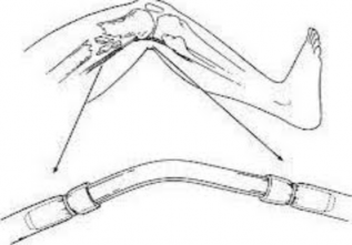 Hình 2 2 Sử dụng ống silicon làm cầu nối động mạch khoeo Kiểm tra kết quả 2
