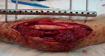 Ảnh 2 1 Hình ảnh kết hợp xương chày bằng khung F E S S A Bệnh nhân Lưu Trung 3