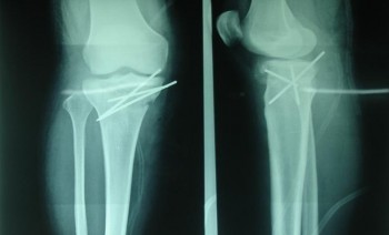 Ảnh 2 2 Hình ảnh XQ kết hợp mâm chày bằng đinh Kirschner Bệnh nhân Nguyễn 4