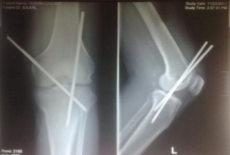 Ảnh 2 3 Hình ảnh XQ cố định khớp gối bằng đinh Steinmann Bệnh nhân Vũ Đình 5