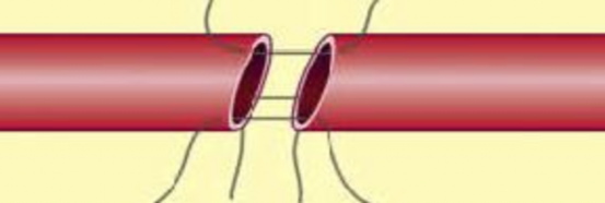 Hình 2 3 Nối động mạch tận – tận • Ghép đoạn động mạch bằng tĩnh 1