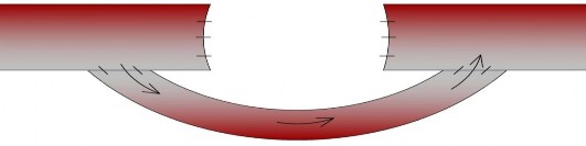 Hình 2 5 Bắc cầu động mạch bằng tĩnh mạch tự thân ngoài vùng giải phẫu 3