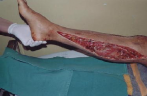 Ảnh 2 5 Đường mở cân sau trong cẳng chân Bệnh nhân Phạm Tiến A 17 tuổi Số 4