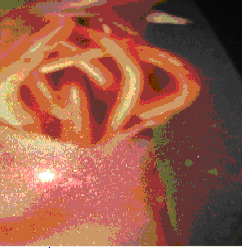 Hình 1 5 Hoại tử ruột do giun đũa www portalesmedicos com Theo một số tác giả 1