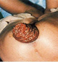 Hình 1 6 Sa trực tràng do giun tóc www telmeds org Giun tóc trực tiếp hút máu đồng 2