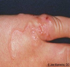 Hình 1 7 Ấu trùng giun móc mỏ gây viêm da http www aocd org cutaneous larva migran 4