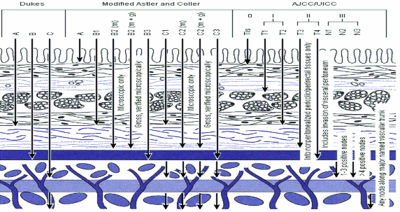 Hình 1 9 Phân loại Dukes cải tiến và TNM 74 1 3 3 Xếp độ mô học Năm 1925 5