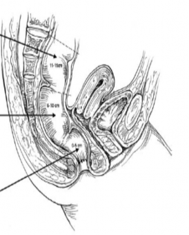 1 3 trên Cắt toàn bộ mạc treo trực tràng Cắt trước thấp LAR LAR Hóa 1