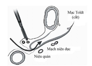 Hình 2 5 Đường cắt từ cạnh bên và giữa của kết tràng sigma đi theo bờ sau 4