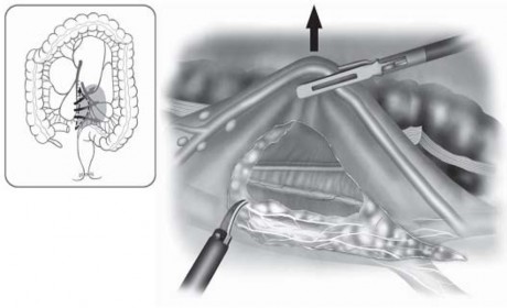 Hình 2 6 Đường phẫu tích mạch máu theo hướng từ trong ra ngoài Masahiko Watanabe 5