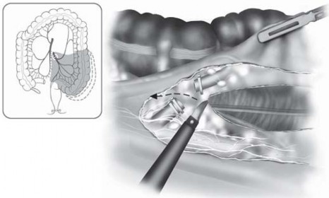 Hình 2 7 Phẫu tích và giải phóng mạc treo sigma Masahiko Watanabe 2006 112 Hình 6