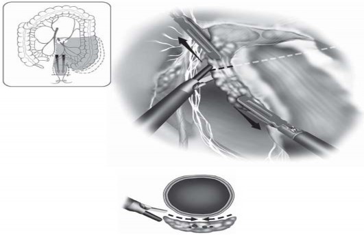 Hình 2 8 Phẫu tích và cắt mạc treo trực tràng TME Masahiko Watanabe 2006 112 Ở 7