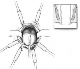 Hình 2 13 Kéo pullthrough kết tràng ra nối với ống hậu môn Masahiko Watanabe 3