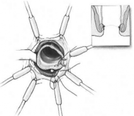 Hình 2 13 Kéo pullthrough kết tràng ra nối với ống hậu môn Masahiko Watanabe 4
