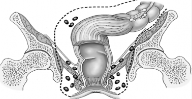 Hình 2 15 Đường khoét hậu môn trong phẫu thuật Miles 85 2 2 3 Nghiên cứu kết 6