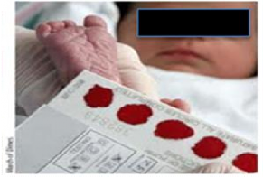 Hình 1 2 Lấy mẫu xét nghiệm chẩn đoán nhiễm HIV bằng bộ dụng cụ lấy giọt 1