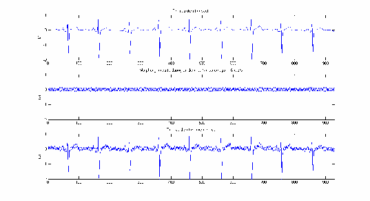 Hình 3 14 Biểu diễn trong miền thời gian các tín hiệu S n N n và NoisyECG 1