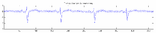 Hình 1 3 Ảnh hưởng của nhiễu từ mạng cung cấp điện 1 1 4 Nhiễu do run cơ 2