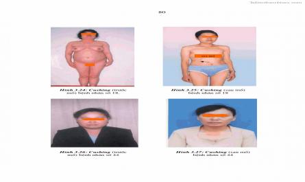 Luận án tiến sĩ y học Nghiên cứu chẩn đoán và điều trị phẫu thuật nội soi các u tuyến thượng thận lành tính tại bệnh viện Việt Đức giai đoạn 1998 - 2005 - 16