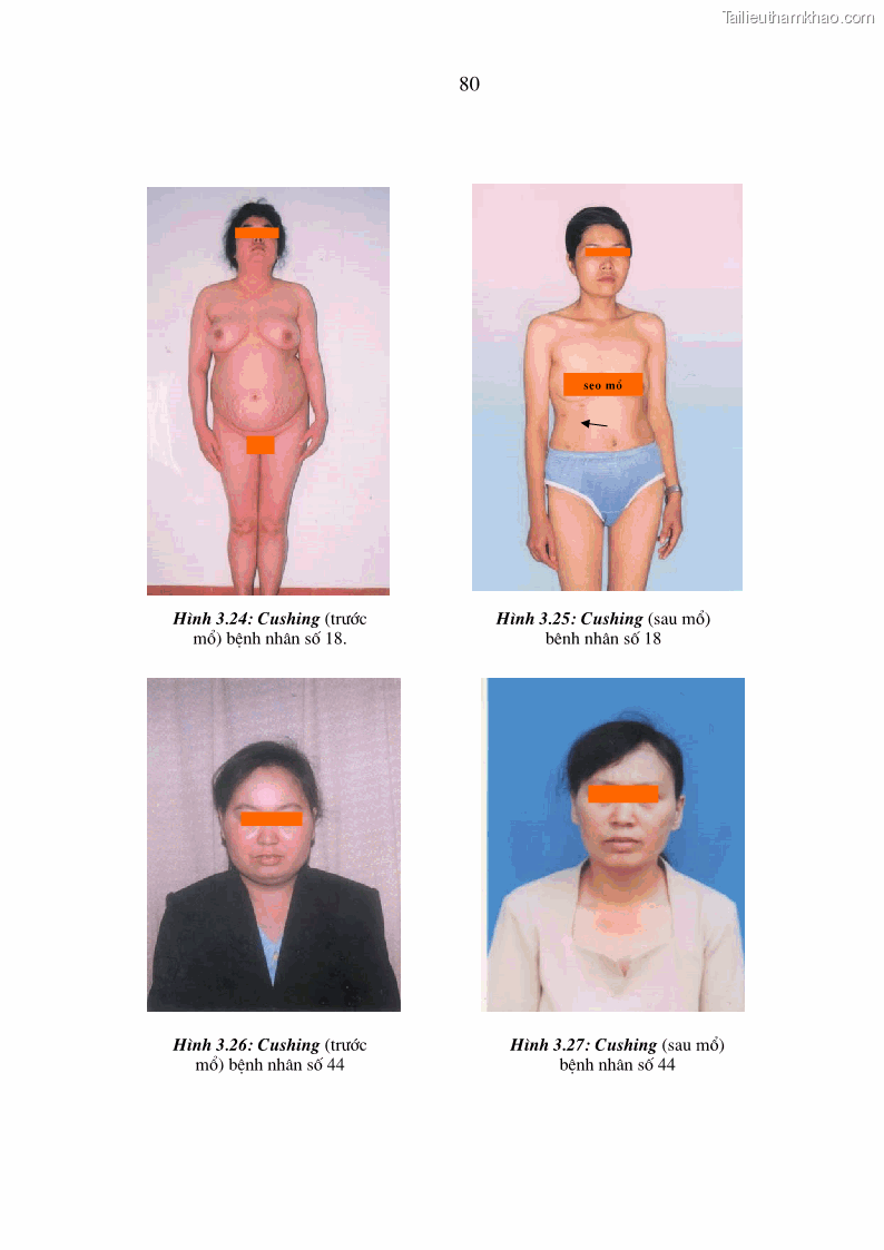 Luận án tiến sĩ y học Nghiên cứu chẩn đoán và điều trị phẫu thuật nội soi các u tuyến thượng thận lành tính tại bệnh viện Việt Đức giai đoạn 1998 - 2005 - 16 Trang 91